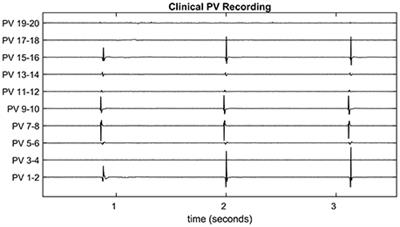 Signal Reconstruction of Pulmonary Vein Recordings Using a Phenomenological Mathematical Model: Application to Pulmonary Vein Isolation Therapy